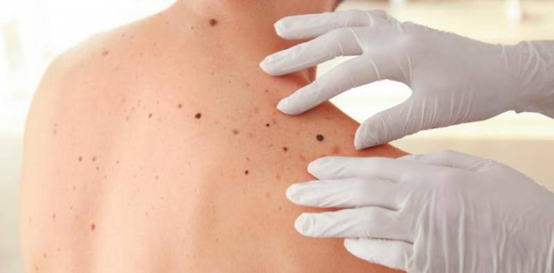 Έρευνα: Ο καρκίνος του δέρματος πάνω από τον λαιμό είναι πιο πιθανό να κάνει μετάσταση