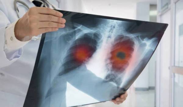 Έρευνα εντοπίζει άγνωστο μοριακό μονοπάτι για την αναχαίτιση του καρκίνου του πνεύμονα