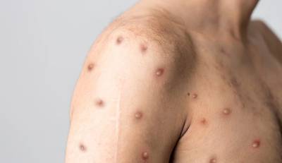 Ευλογιά των πιθήκων: Στα 54 τα κρούσματα στην Ελλάδα