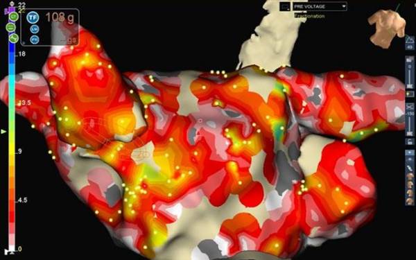 Νέο σύστημα με καινοτόμο τεχνολογία καρδιακής χαρτογράφησης στο Ωνάσειο