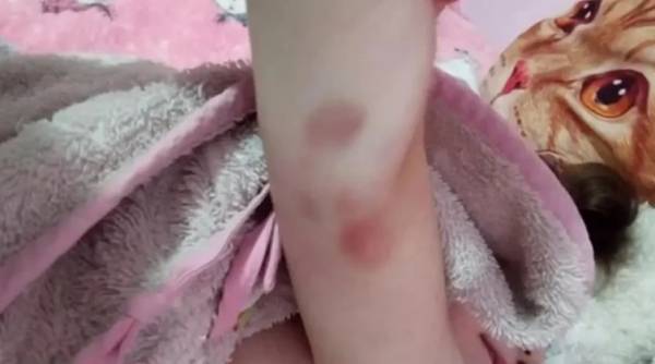 Νεκρά παιδιά στην Πάτρα: Φωτογραφία - ντοκουμέντο με μελανιές στο χέρι της Τζωρτζίνας (Βίντεο)