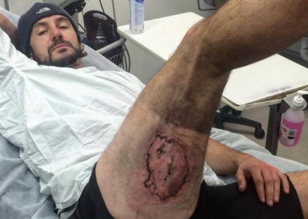 Ποδηλάτης υπέστη εγκαύματα όταν πήρε φωτιά το iPhone του