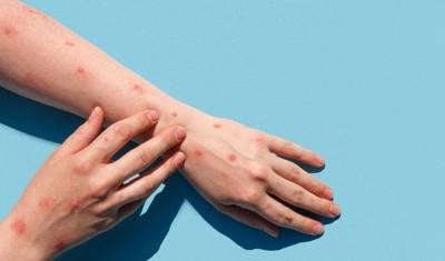 Ευλογιά των πιθήκων: 9 επιβεβαιωμένα κρούσματα σε μια εβδομάδα - Στα 48 ανέρχονται πλέον οι περιπτώσεις