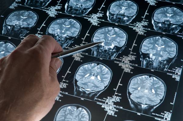 Την πιθανότητα για την εμφάνιση Αλτσχάιμερ και μετά από τραύμα στο κεφάλι, ερευνούν οι επιστήμονες