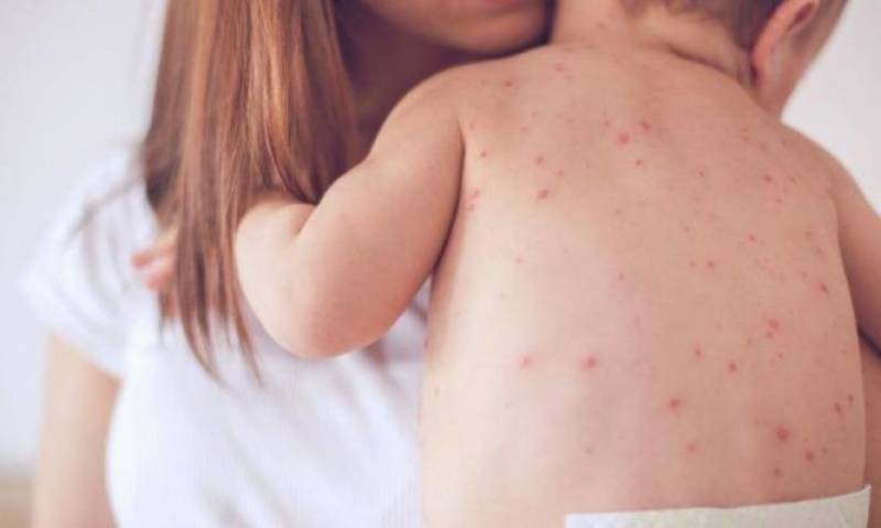 Διπλασιάστηκαν τα κρούσματα ιλαράς σε ένα μήνα στη Μεσσηνία
