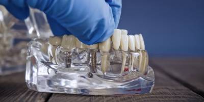 Εμφυτεύματα Δοντιών με σύγχρονες τεχνικές και άμεση αποκατάσταση