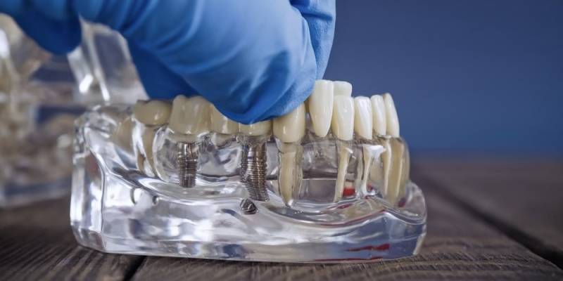 Εμφυτεύματα Δοντιών με σύγχρονες τεχνικές και άμεση αποκατάσταση