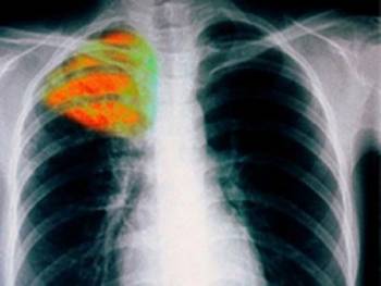24η Μαρτίου: Παγκόσμια Ημέρα κατά της Φυματίωσης