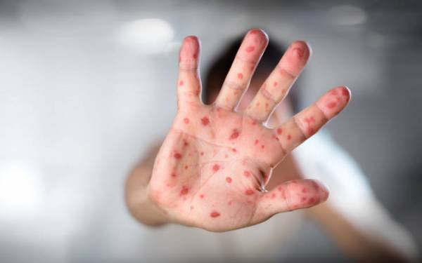 Ανησυχία στις ΗΠΑ για την ιλαρά: Νέο κρούσμα της νόσου