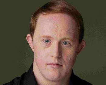 Chris Burke: Ο ηθοποιός που άλλαξε τον τρόπο αντιμετώπισης του συνδρόμου down στις ΗΠΑ