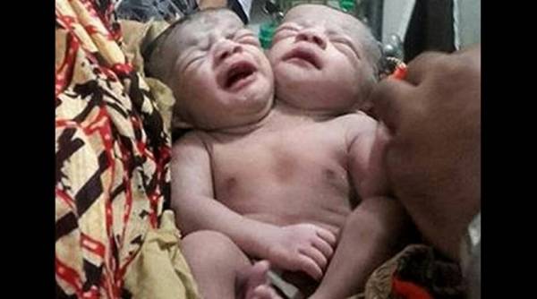 Μωρό με δύο κεφάλια γεννήθηκε στο Μπανγκλαντές