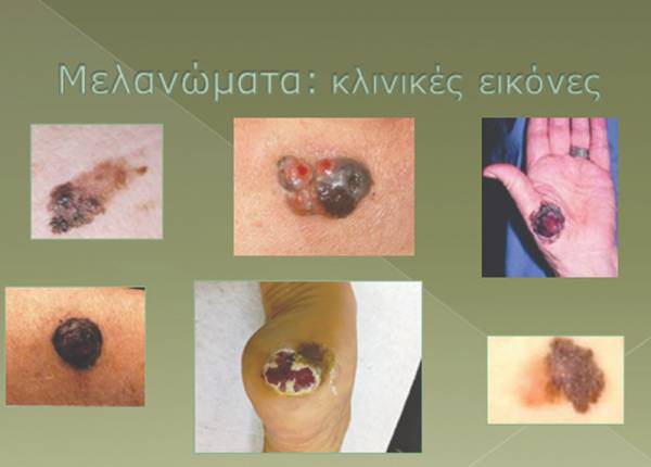 Ραγδαία αύξηση στο μελάνωμα δέρματος στη Νότια Πελοπόννησο