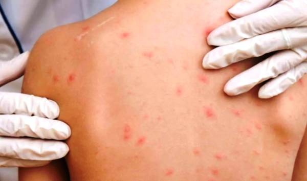ΠΟΥ: Αύξηση κατά 79% των κρουσμάτων ιλαράς