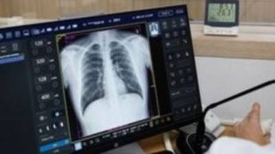 Κυστική Ινωση: 500.000 φορείς στην Ελλάδα και πάνω από 900 οι ασθενείς