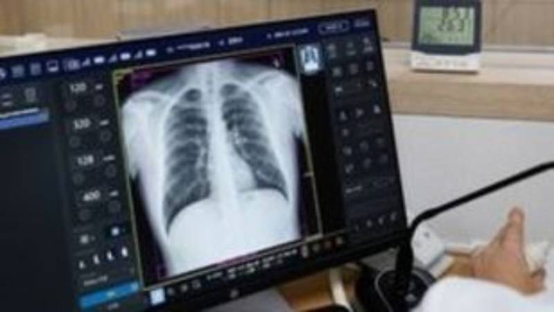 Κυστική Ινωση: 500.000 φορείς στην Ελλάδα και πάνω από 900 οι ασθενείς
