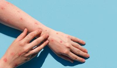 Ευλογιά των πιθήκων: Στα 72 τα κρούσματα στην Ελλάδα