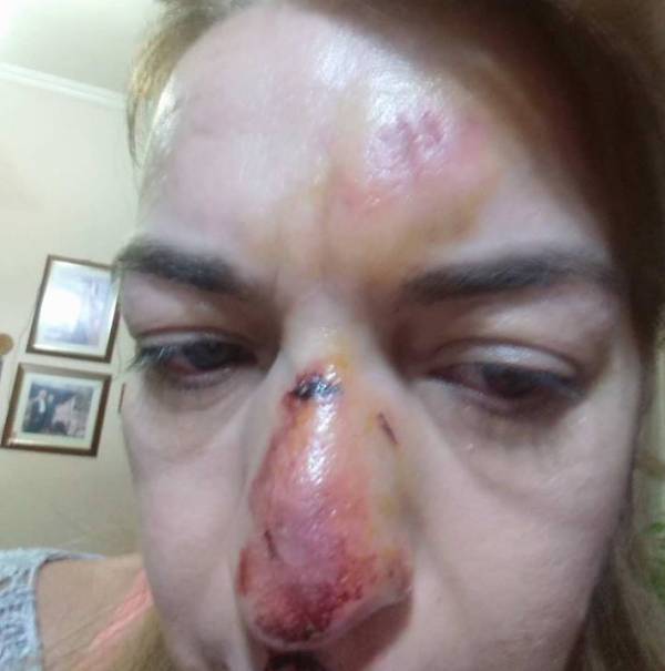 Καλαμάτα: Γυναίκα τραυματίστηκε από κακοτεχνία της ΔΕΥΑΚ σε πεζοδρόμιο